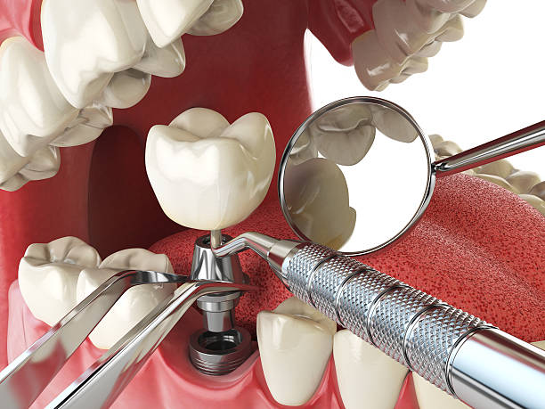 Best Emergency Dental Extractions in Leipsic, OH